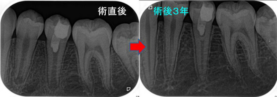 根未完成歯の大きな虫歯治療（生活断髄） - EE DENTAL_Blog